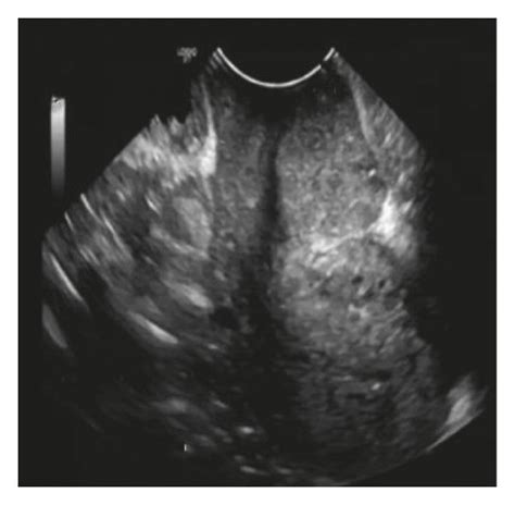 Traditional Ultrasound Image Of Cervical Cancer A An Image Of The
