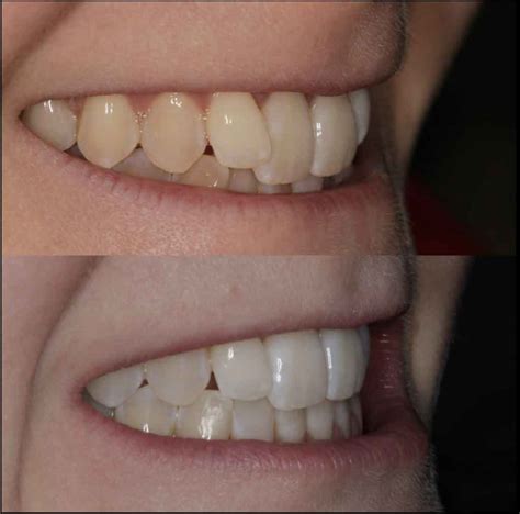 A Delighted Invisalign Client Dentist Leeds Fhdc
