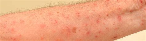 Scabies Total Skin Center