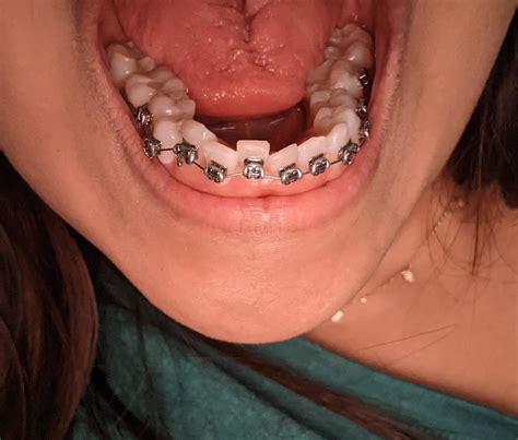 just got my bottom braces r braces