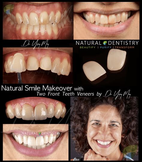 Smile Makeover Before And After