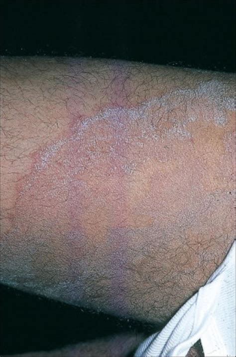 Prevention and treatment of intertrigo in large skin folds of adults: intertrigo groin - pictures, photos