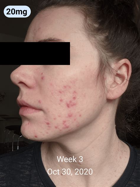 My Low Doselong Term Accutane Journey Details In Comments Raccutane