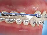 Orthodontic Chains