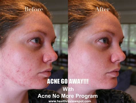 Skin Care Treatment Acne No More Review Mike Walden
