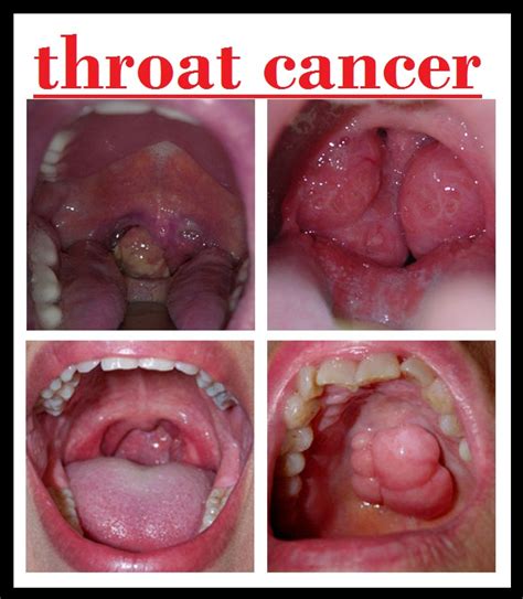 First Signs Of Throat Cancer Pictures Mouth Cancer Pictures What Oral