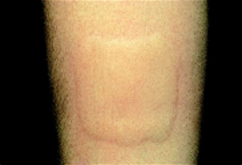 Allergy And The Skin I—urticaria The Bmj