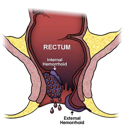 Internal hemorrhoids do not usually have symptoms because of a lack of sensory nerve endings in the rectum. Hemorrhoids - Southwest Surgical Associates