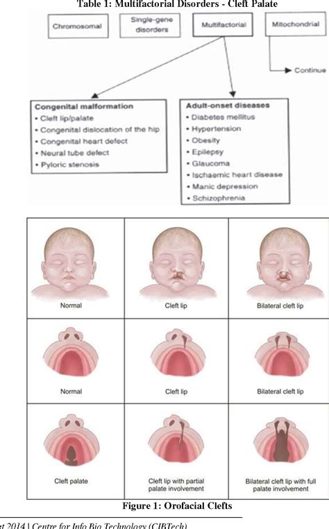 Cleft Palate Types