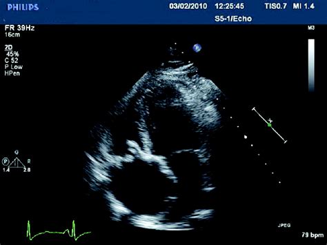 Percutaneous Tricuspid Valve Replacement For A Stenosed Bioprosthesis