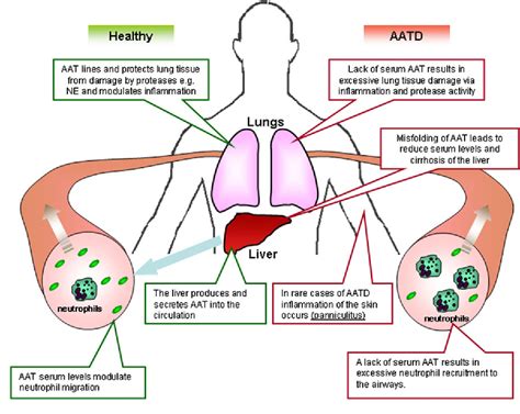 Alpha 1 Antitrypsin A Potent Anti Inflammatory And Potential Novel