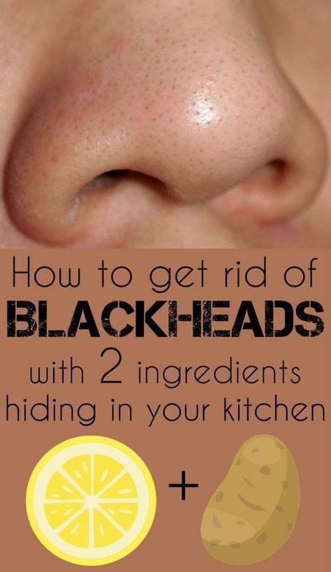 How To Get Rid Of Blackheads With Two Ingredients Hiding In Your