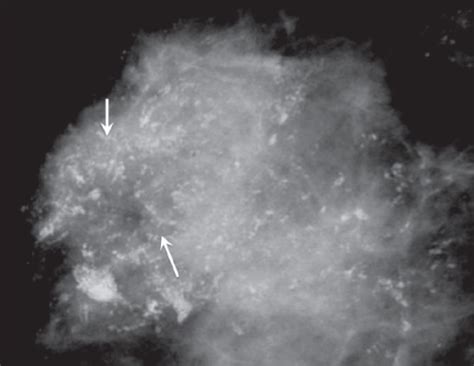 Mammogram Shows Pleomorphic Calcifications Arrows In Open I