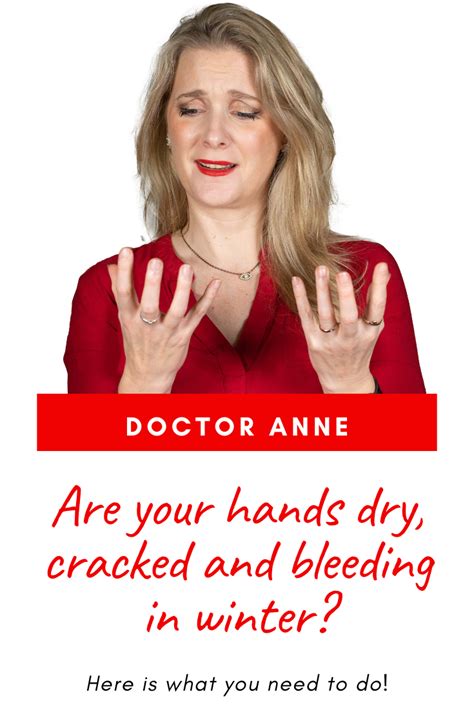 Dry Cracked And Bleeding Hands This Is What You Need To Do Ask