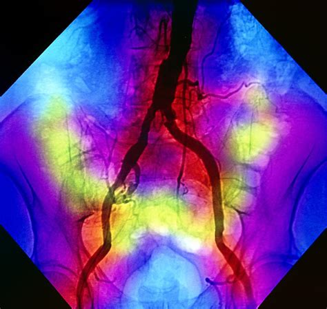 False Colour Normal Abdominal Angiogram Photograph By Mehau Kulyk