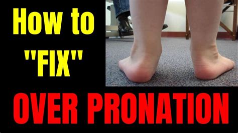How To Really Fix Overpronation Flat Feet And Collapsed Arches Truth Exercises Youtube