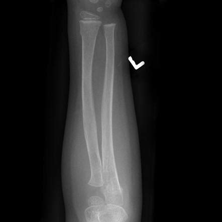 Torus Fracture Radiology Reference Article Radiopaedia Org