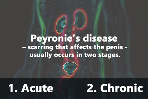 Peyronies Disease Manchester Urology Associates Pa