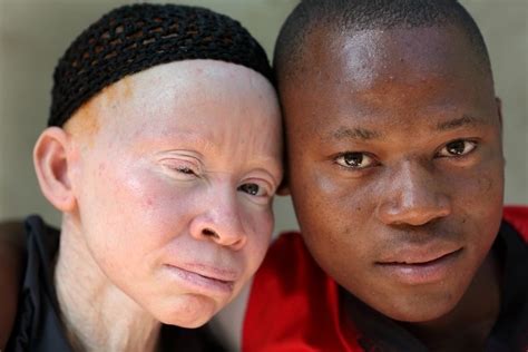 Albinisme Gejala Penyebab Dan Mengobati Alodokter