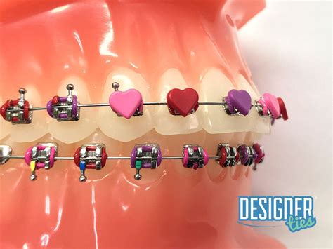 Designer Ties Exclusively From Gandh Orthodontics Getting Braces Cute Braces Colors Braces Colors