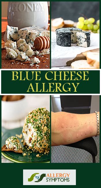 Blue Cheese Allergy Allergy