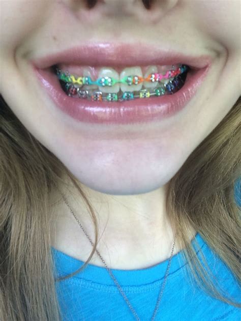 Technicolor Braces Aren T They Cool It S Like Having A Rainbow Mouth