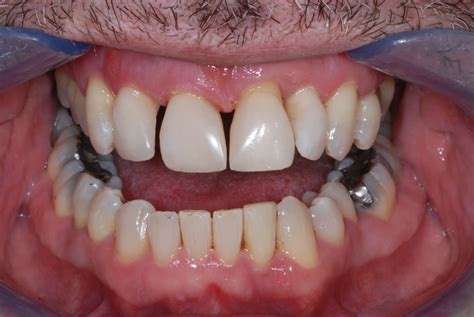 Tooth bands can cause teeth to close at an angle, weakening their position in the gum. Fillings - Clover House Dental Practice