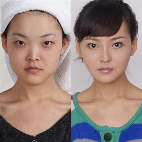 Cosmetic Surgery Before And After Photos From Korea Popsugar Beauty