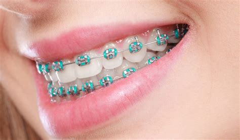 Different Types Of Cosmetic Dentistry Braces Medical Reasons For All