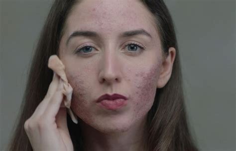 Bbc Three Show Skin Raises Awareness Of Skin Conditions