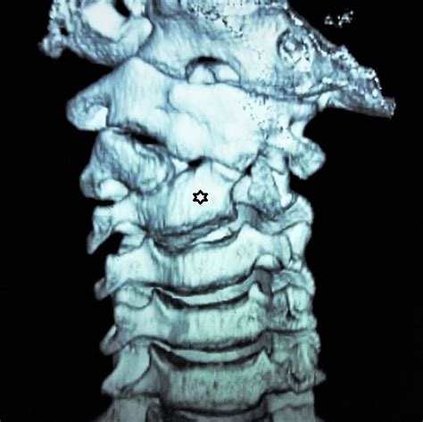 Hemivertebra Of The Cervical Spine An Uncommon Background For Neck