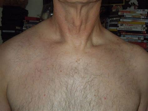 Swollen Lymph Nodes Above Collar Bone