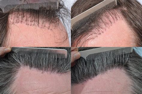 Bald Scalp Hair Transplant Before And After Photos