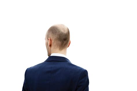 Could Baldness Predict Other Health Risks Tmc News