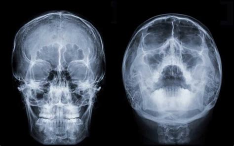 Radiografias Dos Seios Da Face Tomos D
