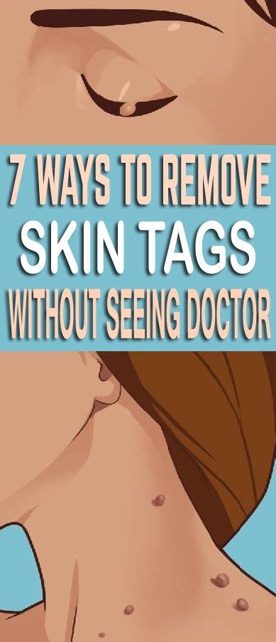 7 easy ways to remove skin tags without seeing a doctor skin tag removal skin tag skin