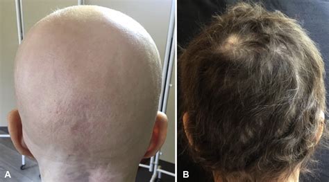 Treatment Of Severe Alopecia Areata With Baricitinib Jaad Case Reports