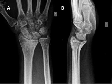 The Malunion Of Distal Radius Fracture Corrective Osteotomy Through