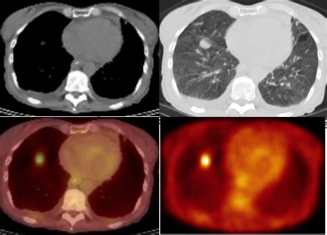 Our review of embrace found that the company. F 18 Fdg Pet Ct