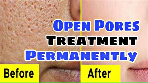 🔵open Pores Permanent Treatment Open Pores कैसे ठीक करें Youtube