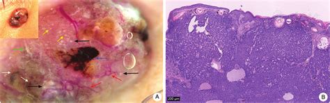 Dermoscopic Features Of Basal Cell Carcinoma And Their Association With