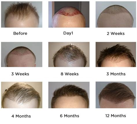 Here Is What We Learn About The Hair Transplant In Uk（2019）