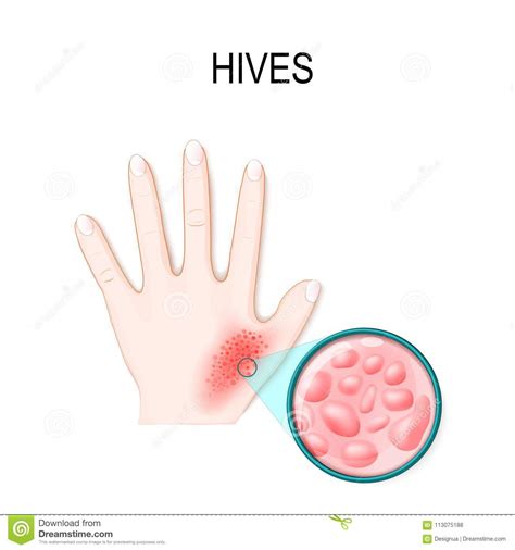Skin Rash Hives Or Urticaria Stock Vector Illustration Of Eruption
