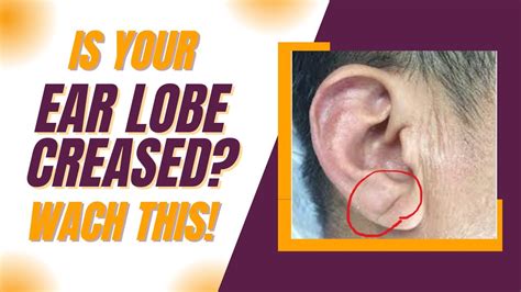 Detecting Heart Disease With Earlobe Crease What Research Says Youtube
