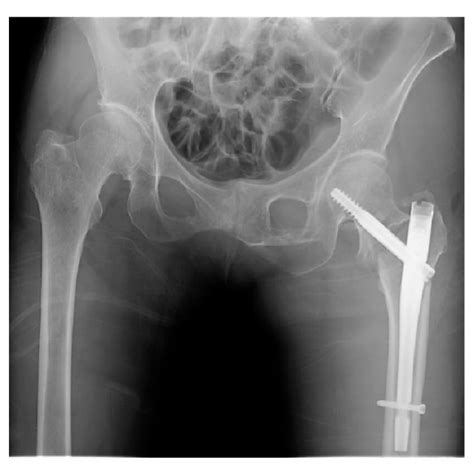 Radiographs After The Osteosynthesis Of The Left Trochanteric Fracture