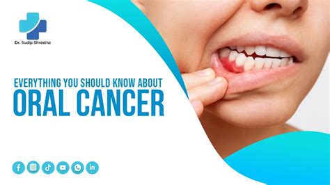 Everything You Should Know About Oral Cancer