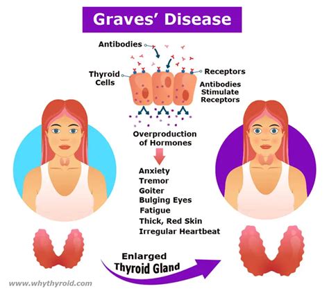 Graves Disease Causes Symptoms Diagnosis Treatment Why Thyroid