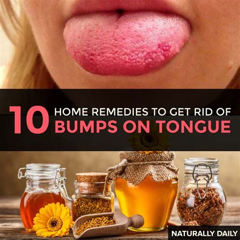 Brushing your teeth at least twice daily, and using mouthwash to rid the mouth of harmful bacteria. How to Get Rid of Lie Bumps on Tongue: Top 10 Home Remedies!