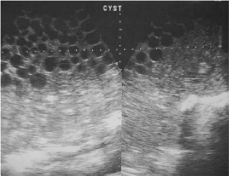 Us Image Shows A Hydatid Cyst With Multiple Daughter Cysts And Hydatid