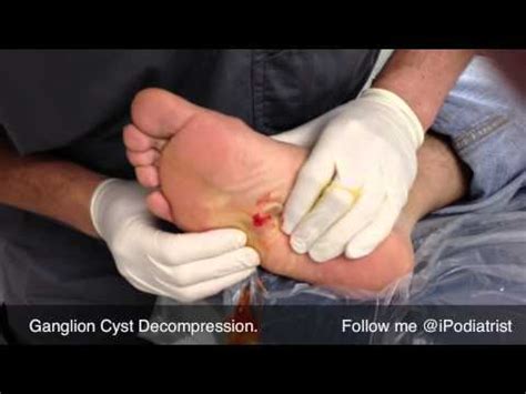 Ganglion Cyst Drained From Foot